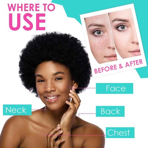 Bye Bye Blemish Acne Drying Lotion, Reduce Pimples Overnight, On-the-Spot Pimple Treatment, Beauty Skincare Essential - 1oz. (3 Pack)