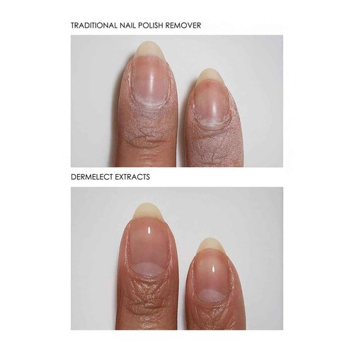 Dermelect Clean & Care Nail Renewal Kit – Nailcare Treatment Set with Ridge Filler, Nail Brightener & Polish Remover Wipes – Strengthens, Brightens & Restores Damaged, Discolored, Weak Nails