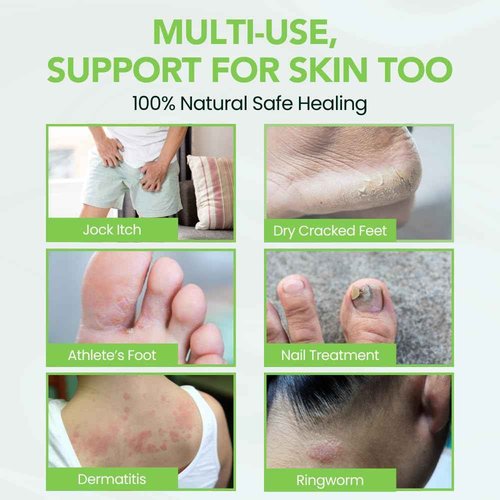 Thena Athletes Foot Cream Extra Strength Herbal Relief with Tea Tree Neem & Menthol, Athletes Foot Treatment Balm for Itchy Dry Cracked Feet, Heels & Toes, Advanced Plant-Based Foot Care