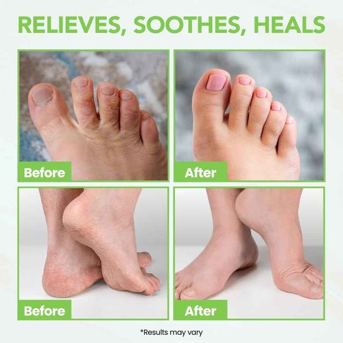 Thena Athletes Foot Cream Extra Strength Herbal Relief with Tea Tree Neem & Menthol, Athletes Foot Treatment Balm for Itchy Dry Cracked Feet, Heels & Toes, Advanced Plant-Based Foot Care