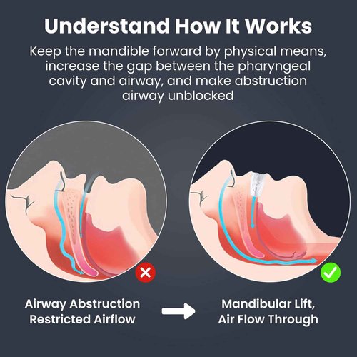 Anti Grinding Guard: Mouth Guard for Teeth Grinding Sleeping - Dental Guard for Men & Women, BPA-Free & Reusable-DT01