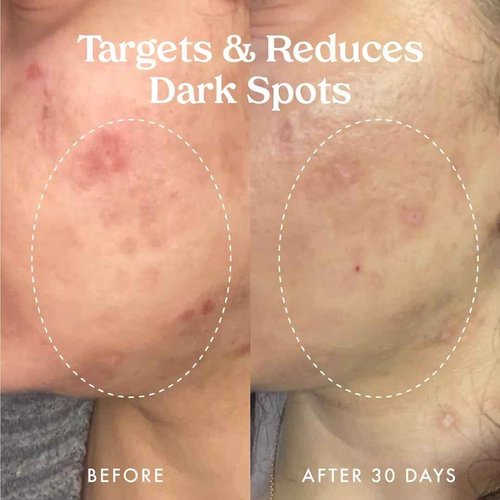 Kopari Star Bright Vitamin C Discoloration Correcting Serum with Kakadu Plum & Niacinamide, Brighter Complexion, Soothe & Diminish Dull Skin, 1.7oz