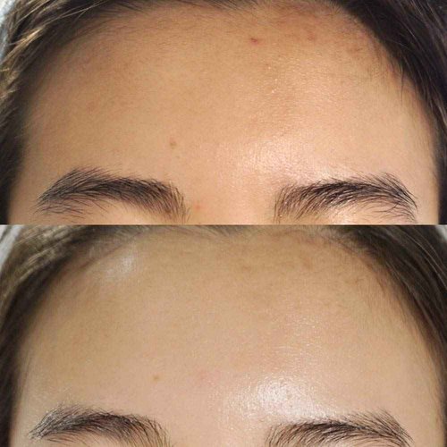 BONAJOUR] Extreme Acne Blemish repair&Soothing Cream - Intensive care for Acne and Skin Barrier Cream 1.75 fl.oz