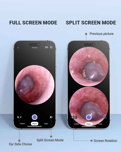 AnyScope Wireless Otoscope with Gyroscope, Ear Camera with Dual View, 3.9 mm Otoscope with Light, Ear Scope with Ear Wax Removal Tool for Kids, Adults, and Pets, Compatible with iPhone and Android