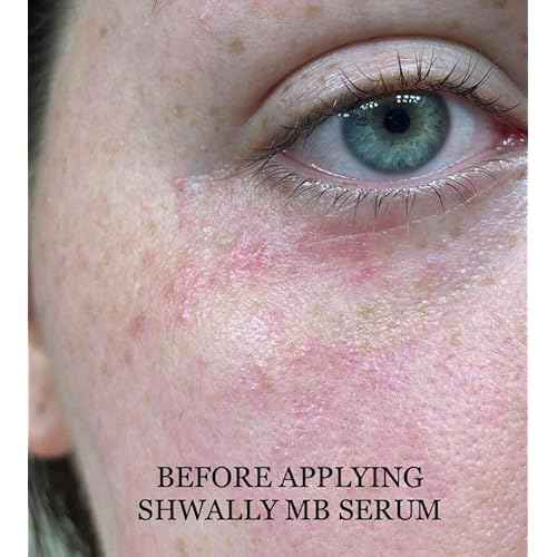 Shwally Methylene Blue Serums (Clear Spot Treatment, 1oz)