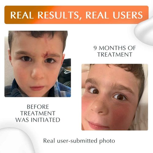 MyNewGel Plus UV Advanced Silicone Scar Gel | Old & New Scars | SPF30 Mineral non-chemical Sunscreen | Ideal for Protecting Scars | Harmful Ultraviolet Rays, 15g (0.5 oz)