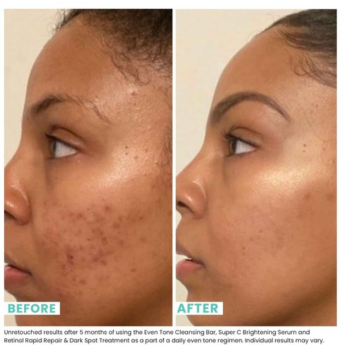 Urban Skin Rx 2-Pack Even Tone & Clear Skin Cleansing Bar Duo | Helps Diminish Look of Dark Spots & Blemishes, Removes Excess Oil, 3-in-1 Daily Cleanser, Exfoliant & Mask Includes (2) 2.0 Oz Bars