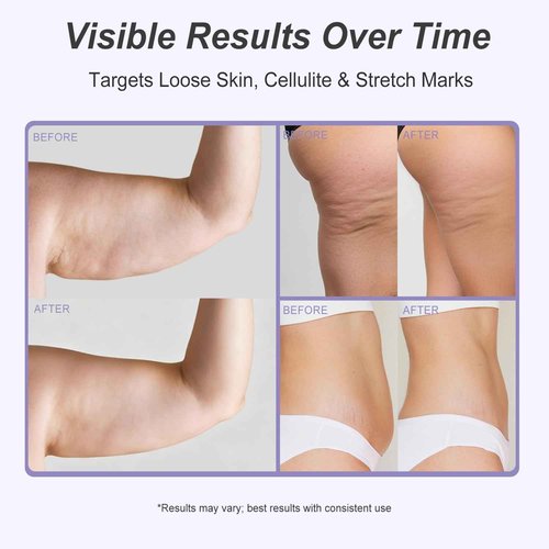 Solivetta Dreamy Glow Overnight Toning Whip Cream – Anti Cellulite & Tightening Loose Skin for Body – LIFTONIN® Get Firming Cream with Satin Eye Mask 3.38 fl oz