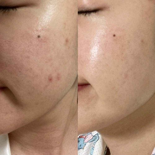 BONAJOUR] Extreme Acne Blemish repair&Soothing Cream - Intensive care for Acne and Skin Barrier Cream 1.75 fl.oz