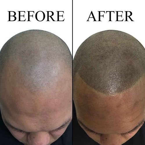 Nuva Follifill SMP Pigment & Cartridge Needle Kit – Deepest Scalp Micropigmentation Ink with Superior Retention, 15ml Bottle for 50+ Treatments, 20 Sterilized Needles, Mixer, Brown