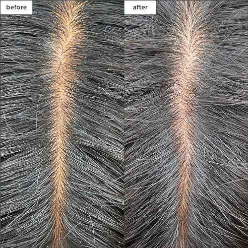 Briogeo Scalp Revival Charcoal + Tea Tree Cooling Hydration Scalp Mask, Dry Scalp Treatment and Moisturizer, Soothes a Dry, Flaky, Itchy Scalp, Treatment for Oily Scalp, Vegan, Cruelty-Free, 6 fl oz