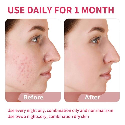 Azelaic Acid Acne Cream: Azelaic Acid For Face - Premium Azelaic Acid Cream - Face Skin and Beauty Care - Azelaic Acid Facial Cream, 20G (2)