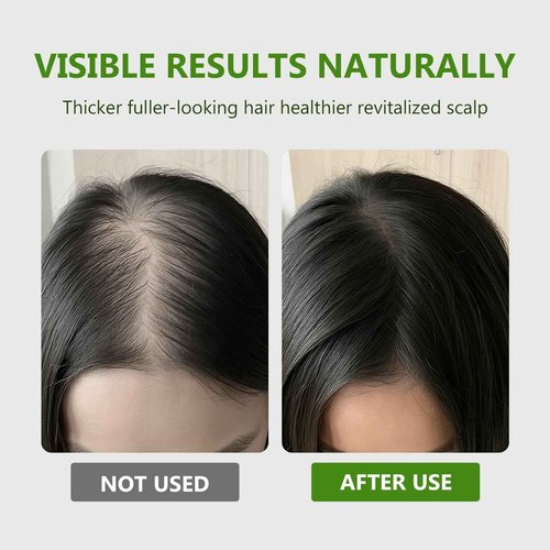 Hair Regrowth System, Hair Growth Serum with Micro Roller & Ginger, Rosemary for Women & Men, Fights Thinning Hair for Thicker Healthier Hair in Several Weeks