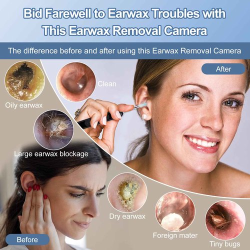 Ear Wax Removal, Ear Cleaner with 1080P HD Camera, with 6 LED Lights/IP67 Waterproof Lens/8 Traditional Tools Ear Wax Removal Kit, Rechargeable Ear Cleaning kit for iOS/Android/Tablet, Black
