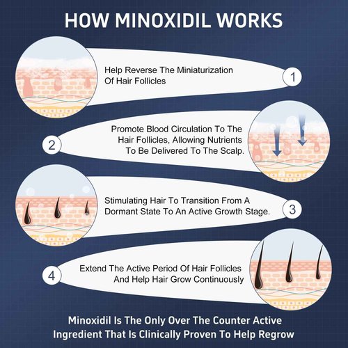 5% Topical Minoxidil Foam, Minoxidil for Men and Women, Infused with Biotin, Hair Growth Treatment, Supports Thicker, Fuller, Healthier Hair & Beard (Foam,6 x 2.11oz,6 Month's Supply)