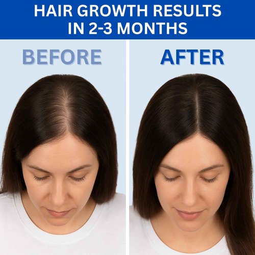 Copper Peptide Hair Serum – 10% GHK-Cu + 5% AHK-Cu Peptides for Hair Growth & Scalp Health – Advanced Regrowth Treatment for Thicker, Fuller Hair