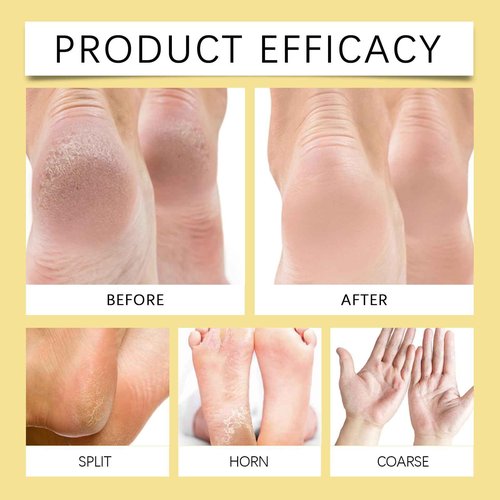 Crack Feet Prevention Stick, Heel Cream For Dry Cracked Feet, Foot Care Cream Moisturizing Foot Balm, Remove Dead Skin And Softening Dry Skin (Pink+Blue)