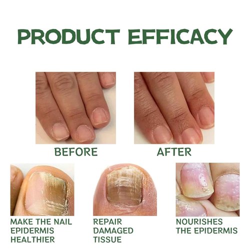 j 3-Pack Nail Fungus Repair Pen: 9ml Tea Tree Oil & Ginger Extract Toenail Treatment Serum