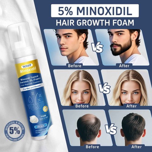 5% Topical Minoxidil Foam, Minoxidil for Men and Women, Infused with Biotin, Hair Growth Treatment, Supports Thicker, Fuller, Healthier Hair & Beard (Foam,6 x 2.11oz,6 Month's Supply)