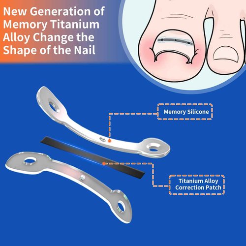 5 Sizes, 10 Pcs - Ingrown Toenail Treatment Kit, Titanium Alloy Ingrown Toenail Removal Kit, Nails Corrector Tool & Remover Strips - Ingrown Toe Nail Quick Relief(0.51/0.59/0.67/0.7/0.74 inches)