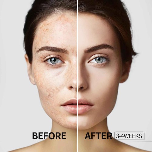 HANYWIL Dark Spot Remover for Face and Body, Dark Spot Corrector Serum, Age Spot Sun Spot Freckles Brown Spot Remover, Melasma Treatment for Face, Skin Care Serum with Roller