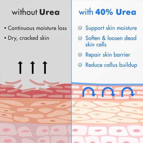 Ebanel Urea Cream 40% plus Salicylic Acid 2%, Foot Cream for Dry Cracked Heels Feet Knees Elbows Hands, Foot Dead Skin Cuticle Callus Remover Toenail Softener, Keratolytic Skin Barrier Repair, 2-Pack