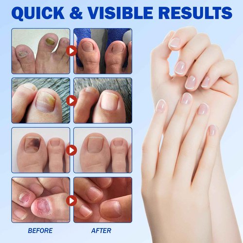 2 Pack Nail Patches-21 Patch Toenail Treatment Extra Strength Renewal Nail Pacthes for Damaged, Discolored, Yellow, Thick, Brittle Toenails 8-Hour Overnight Repair, Breathable & Hypoallergenic