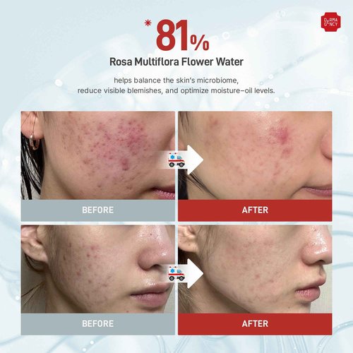 DERMAGENCY Zeroca 81 Korean Calming Cream for Acne-Prone & Sensitive Skin – Lightweight and gentle daily soothing moisturizer, Controls Sebum, Deeply Hydrates & Smooths Texture (2.02 fl.oz. 60 ml)