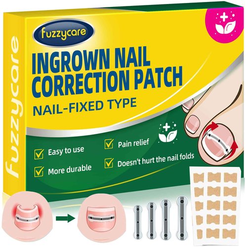 Large Size-Titanium Alloy Ingrown Toenail Treatment & Removal Kit for Quick Relief, Ingrown Toenail Removal Kit， Professional Ingrown Toenail Corrector, Ingrown Toenail Tools for Quick Relief, 10 Pcs