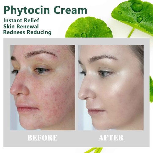 YAMFIUY Centella Moisturizer Phytocin Cream - Phytocin Cream, Moisturizer & Hydration, Improve Roughness, Smooth Skin, For Sensitive Skin with Natural Centella Asiatica Extract 2pcs