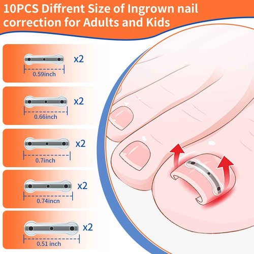 5 Sizes, 10 Pcs - Ingrown Toenail Treatment Kit, Titanium Alloy Ingrown Toenail Removal Kit, Nails Corrector Tool & Remover Strips - Ingrown Toe Nail Quick Relief(0.51/0.59/0.67/0.7/0.74 inches)
