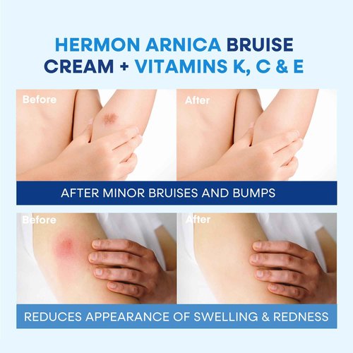 Hermon Arnica Bruise Cream: Reduce Bruising & Swelling on Thin Skin - Arnica Montana with Vitamins K, C & E–Hydrating Moisturizer for Face 4 oz