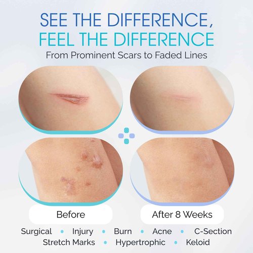 100% Silicone Scar Gel Cream Serum – Silicone + Massage Power Duo Scar Therapy w/Tri-Roller Tip for Surgical, C-Section, Acne, Burn & Keloid Bump Scars – Hypoallergenic & Fragrance Free