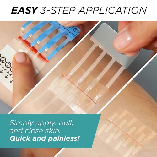Clozex Pediatric Laceration Closures - Repair Wounds Without Stitches, FSA HSA Eligible Skin Closure Device for 3 Individual Wounds Or Combine for Total Length of 2 3/8 Inches