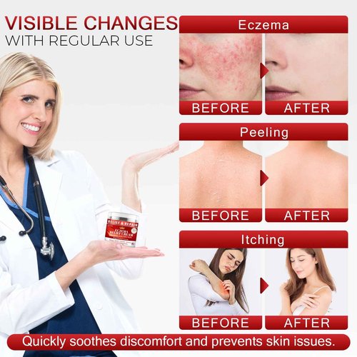 Eczema Cream for Kids & Adults - Eczema Relief Cream for Redness, Itchy, Dry Skin, Daily Moisturizer for Sensitive Skin, with Sea Moss, Aloe Vera, Colloidal Oatmeal, Fragrance-Free, 1.7 FL OZ, 2PC