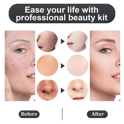 8PCS Blackhead Remover Comedone Extrator Kit, Pimple Extractor Acne Removal Tool Kit, Curved Blackhead Tweezers Kit, Comes with Alcohol Tablets and Magnifying Glasses for Blemish Removal (Gift Box)