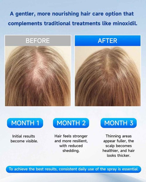 Hair Growth Serum Roll On with Rosemary, Redensyl, Biotin, AnaGain & Niacinamide,No-Rinse & Non-Greasy For All Hair Types (1.01 fl.oz 1Pack, 3% Rosemary)