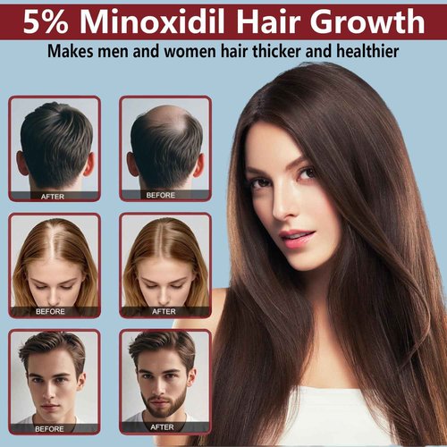 5% Minoxidil for Men and Women Hair Growth Cream, Topical Minoxidil Hair Growth Products, Extra Strength Hair Regrowth Treatments for Stronger Thicker Fuller Hair, 2 Bottles