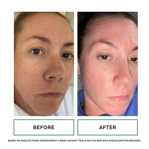 Replenix Glycolic Acid 10% Resurfacing Skin Peel, Medical-Grade Facial Peeling Pads for Discoloration & Acne (60 ct.)