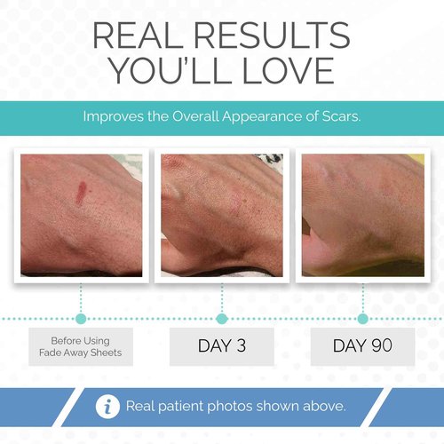 Clinically Proven Silicone Scar Sheets – Medical Grade Tape for Surgery, C-Section, Keloids & Tummy Tuck Scars