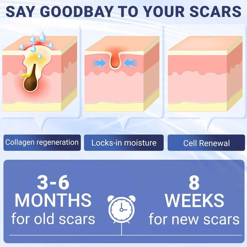 Kunyle Scar Cream, Silicone Scar Gel, Advanced Scar Removal Cream for Surgical Scars, Stretch Marks Removal, Keloid Bump Removal, Old and New Scars 2.11 Oz (60g)