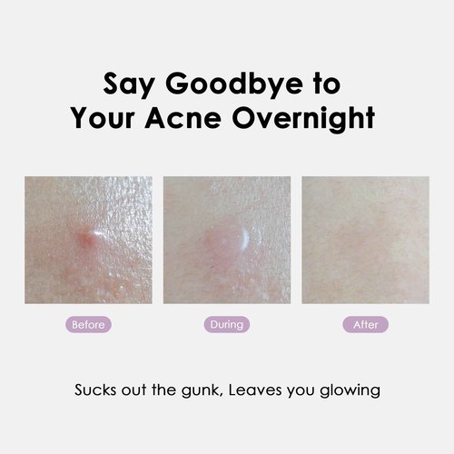 glowiest ASAP Active Spot Alleviating Patch 44 Patches (DUO) 8mm, 10mm, 12mm Spot patches - Premium Hydrocolloid Dressing Dots | Simple & Easy Active Treatment (Pack of 2)