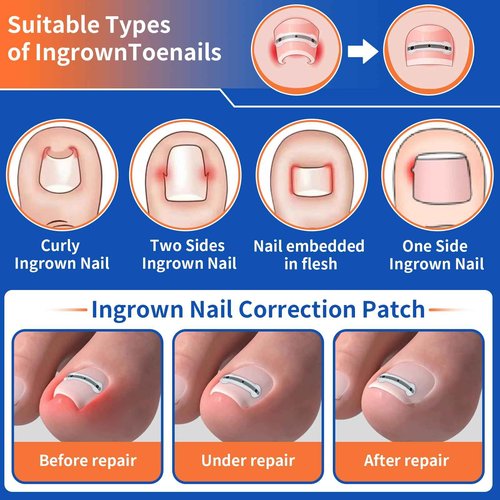 5 Sizes, 10 Pcs - Ingrown Toenail Treatment Kit, Titanium Alloy Ingrown Toenail Removal Kit, Nails Corrector Tool & Remover Strips - Ingrown Toe Nail Quick Relief(0.51/0.59/0.67/0.7/0.74 inches)