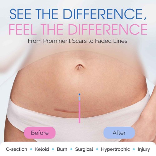 100% Silicone Scar Gel Cream Serum – Silicone + Massage Power Duo Scar Therapy w/Tri-Roller Tip for Surgical, C-Section, Acne, Burn & Keloid Bump Scars – Hypoallergenic & Fragrance Free
