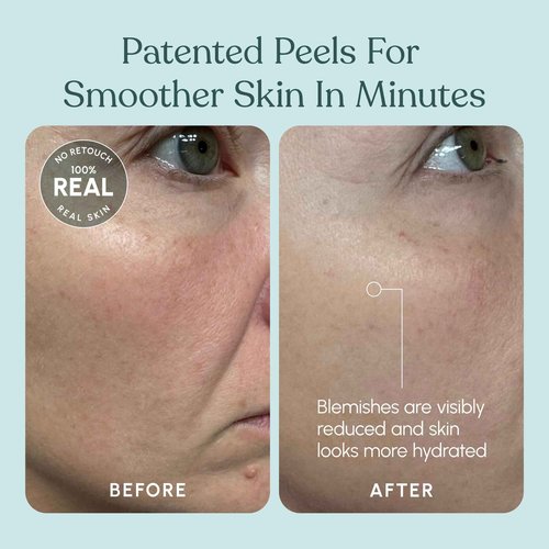 Beautiste 30 DAY MIRACLE AHA 30% + BHA 2% Peeling Solution - Clinical Strength Liquid Exfoliant for Dark Spots, Blackheads & Clogged Pores - Resurfacing Salicylic Acid Serum & Chemical Peel for Face