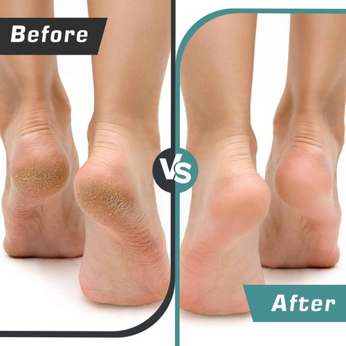 Electric Foot Callus Remover, Electric Foot File, Electric Callus Remover for Feet, Electric Foot Sander Foot Scrubber Foot Filer with 60pcs Replacements Sanding Disc Black
