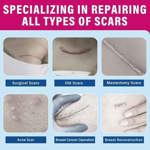 Silicone Scar Sheets, 8 Pcs Medical Grade & Reusable Breast Silicone Scar Tape for Surgical Scars