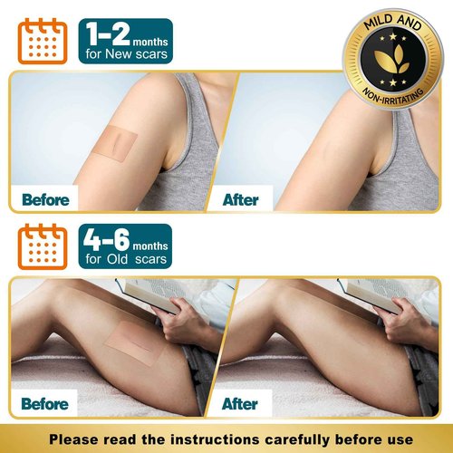 Arme Silicone Scar Tape, 1.6"x480" Silicone Scar Sheets(4 Rolls-12M) Medical Grade Scar Tape for Surgical Scars, Reusable Scar Patches, Professional Scar Removal Strips for C-Section Keloid Tummy Tuck