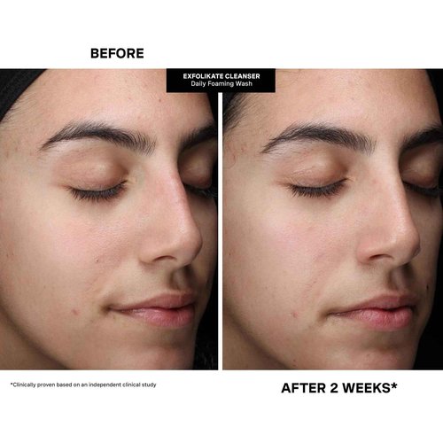 Kate Somerville Pore-fect Skin Edit Travel Kit : ExfoliKate, EradiKate, & Goat Milk Cleanser Holiday Gift Set