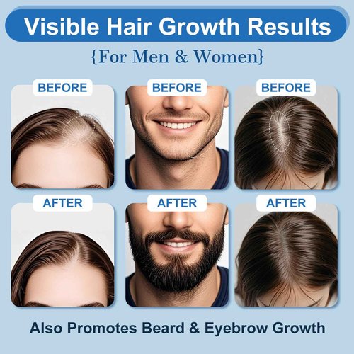 ERYLVEKA 5% Minoxidil Foam for Hair & Beard Growth – Thickening Treatment for Men & Women, 4-Month Supply (8.44oz) with Biotin, Unscented & Non-Greasy Formula
